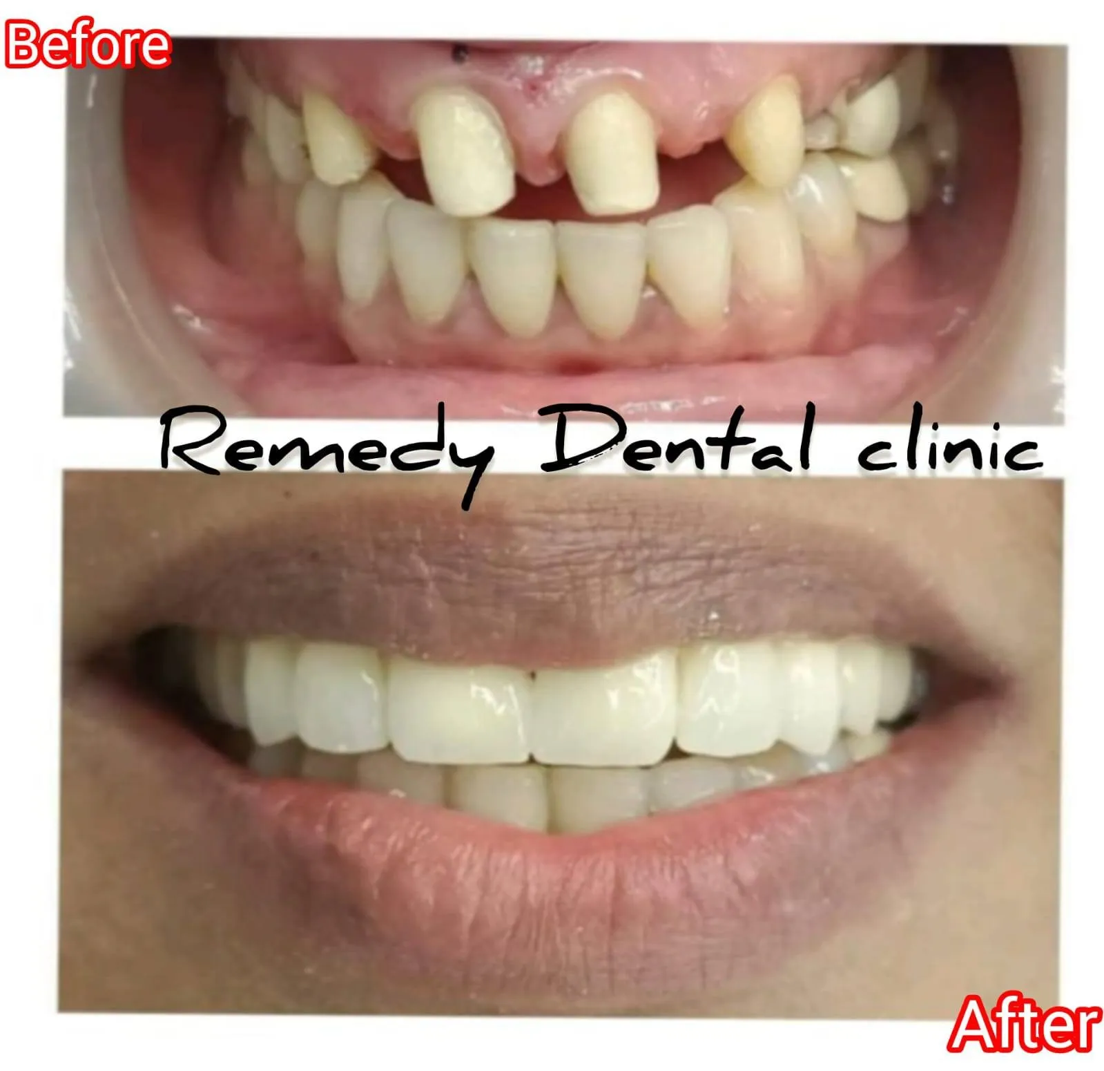 Missing front teeth restored with a full smile makeover — before and after
