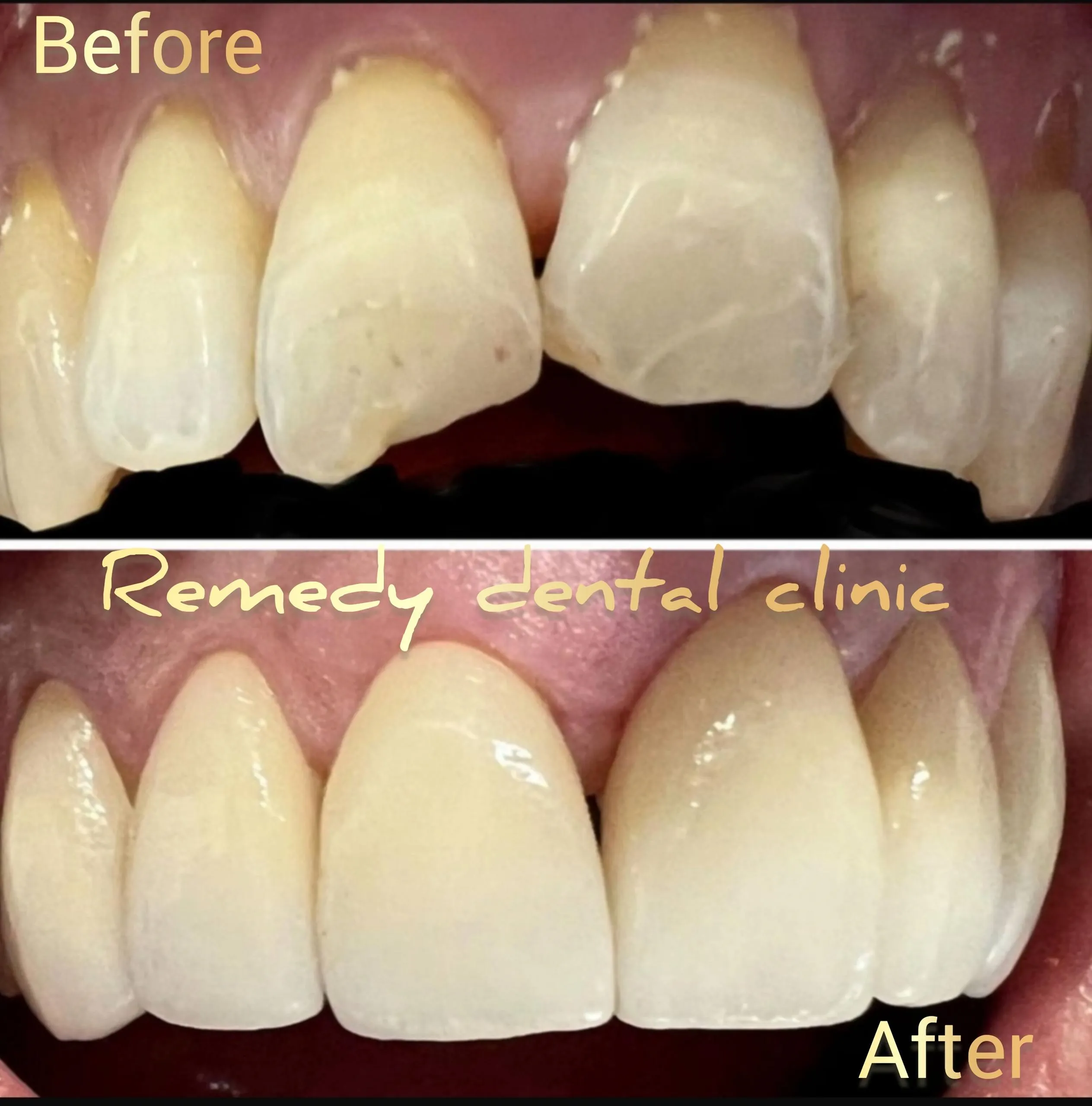 Complete smile makeover — before and after