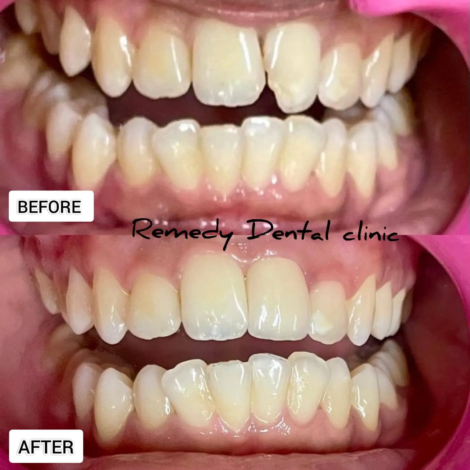 Teeth whitening result at Remedy Dental Clinic — before and after