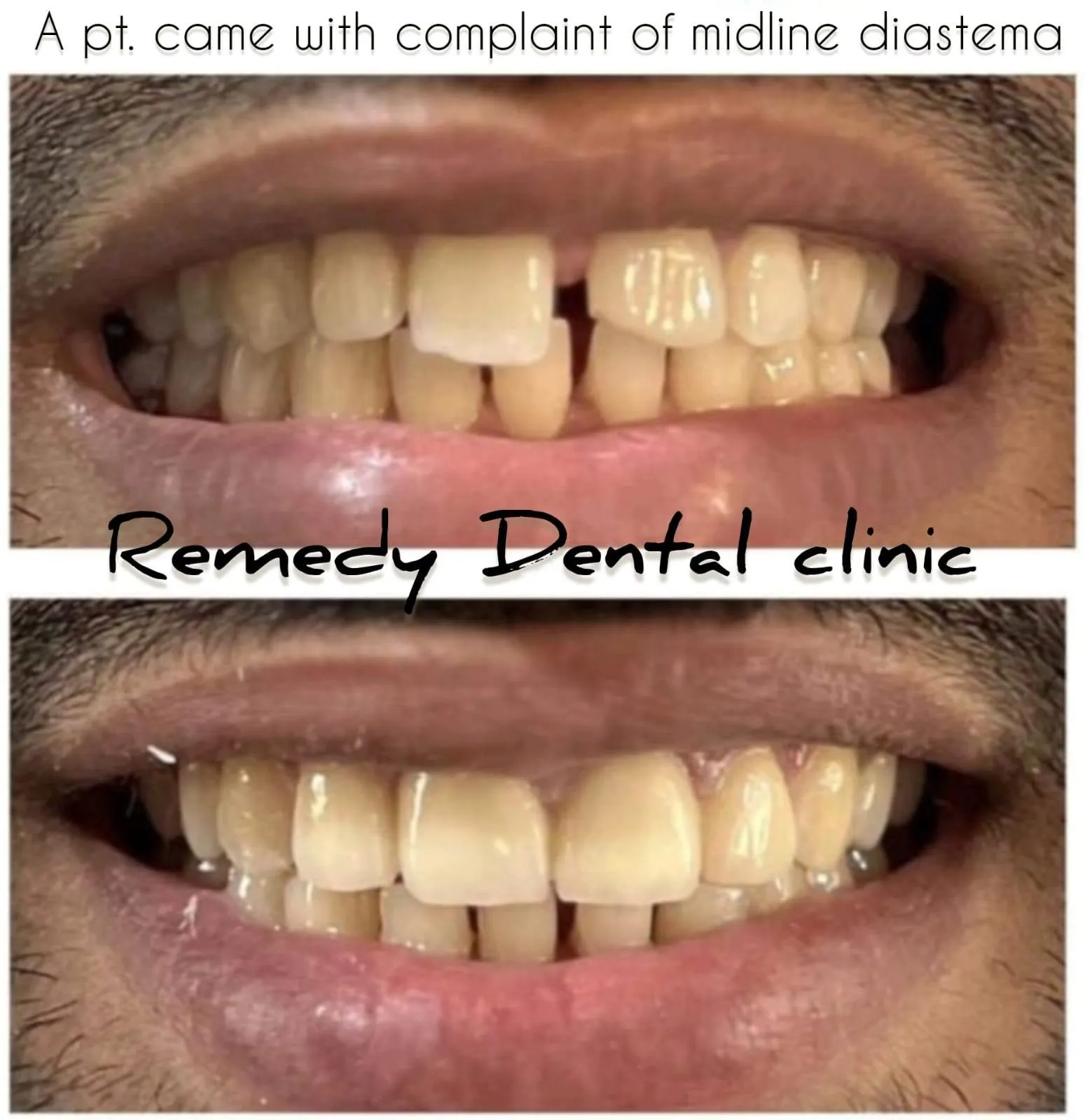 Cosmetic dental restoration — before and after