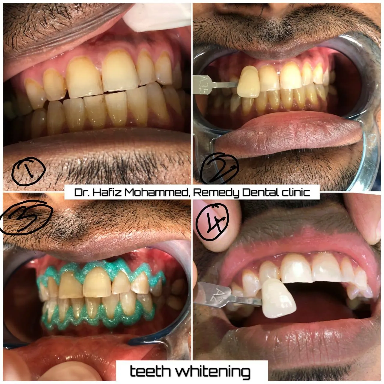 Smile makeover transformation — before and after