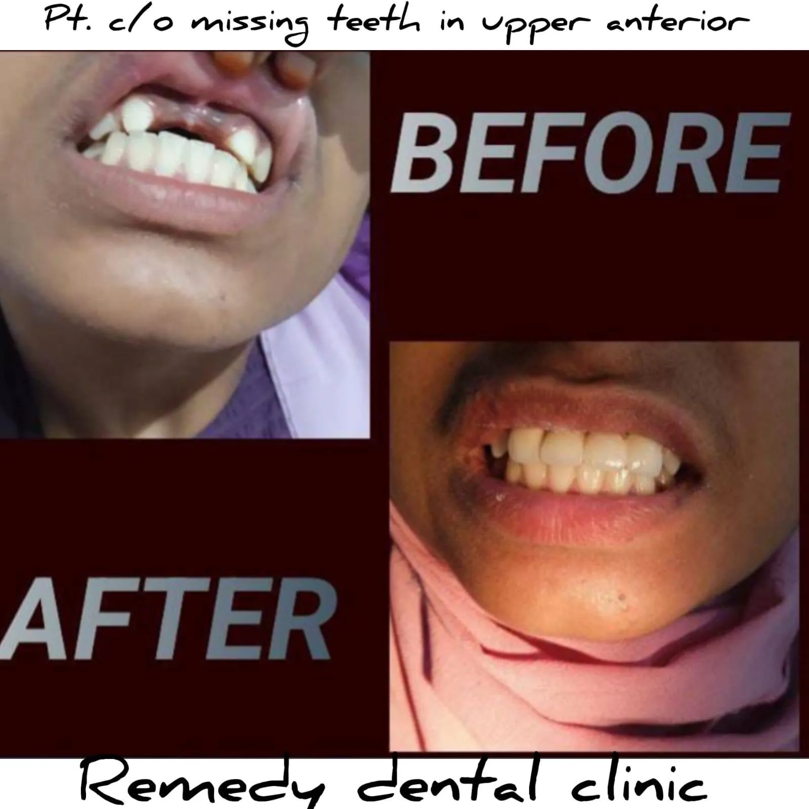 Dental implant restoration with natural-looking result — before and after