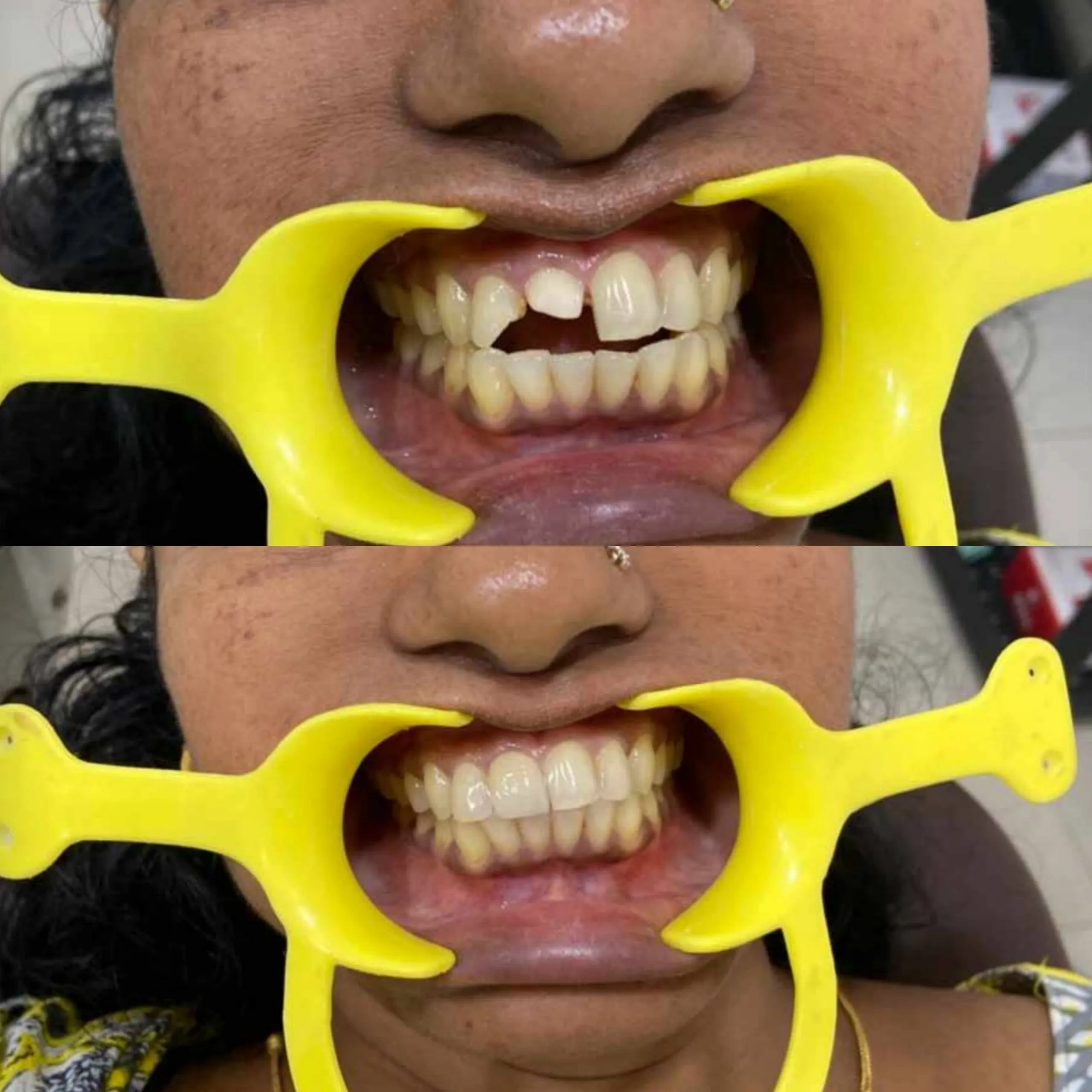 Crown and bridge treatment — before and after
