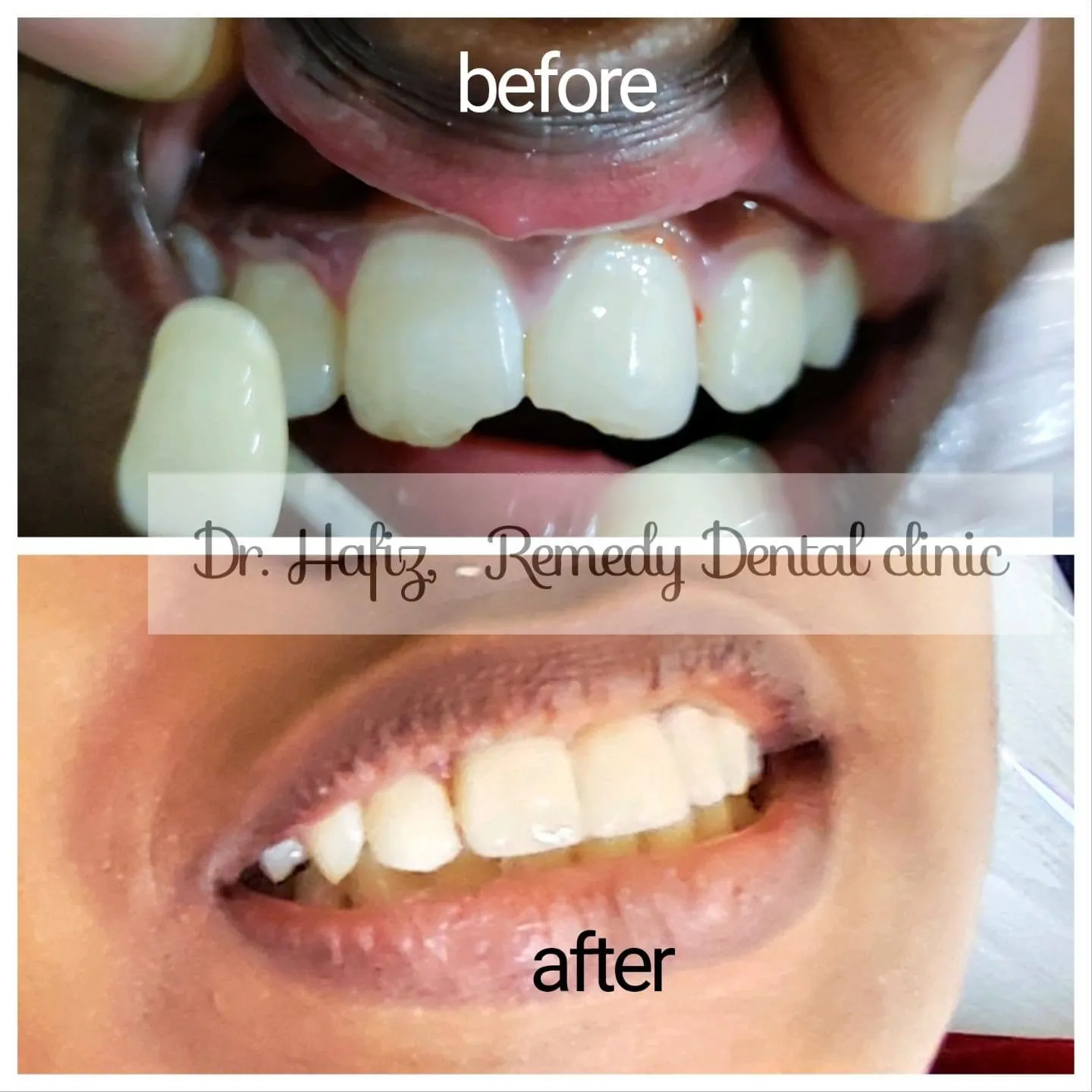 Orthodontic teeth alignment result — before and after