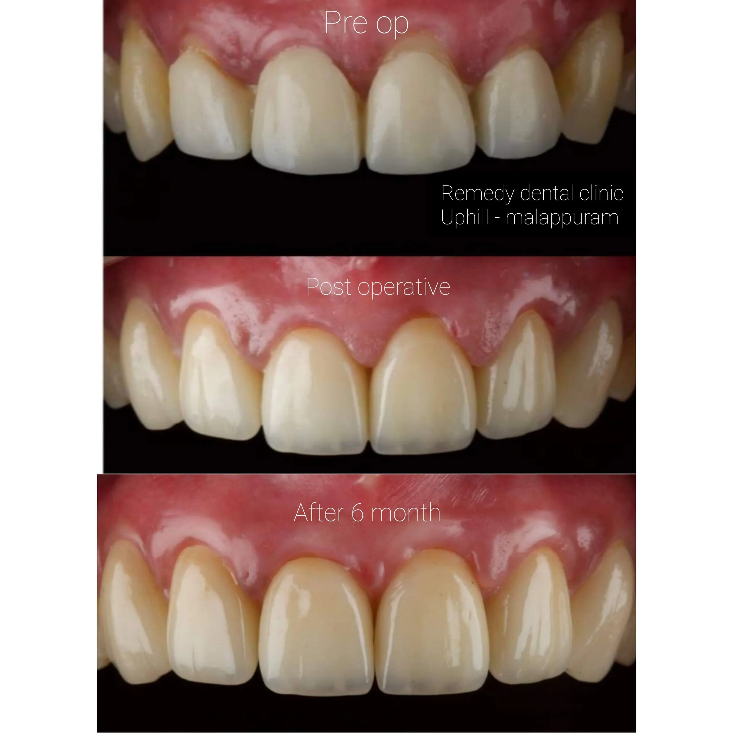 Cosmetic dentistry transformation — before and after