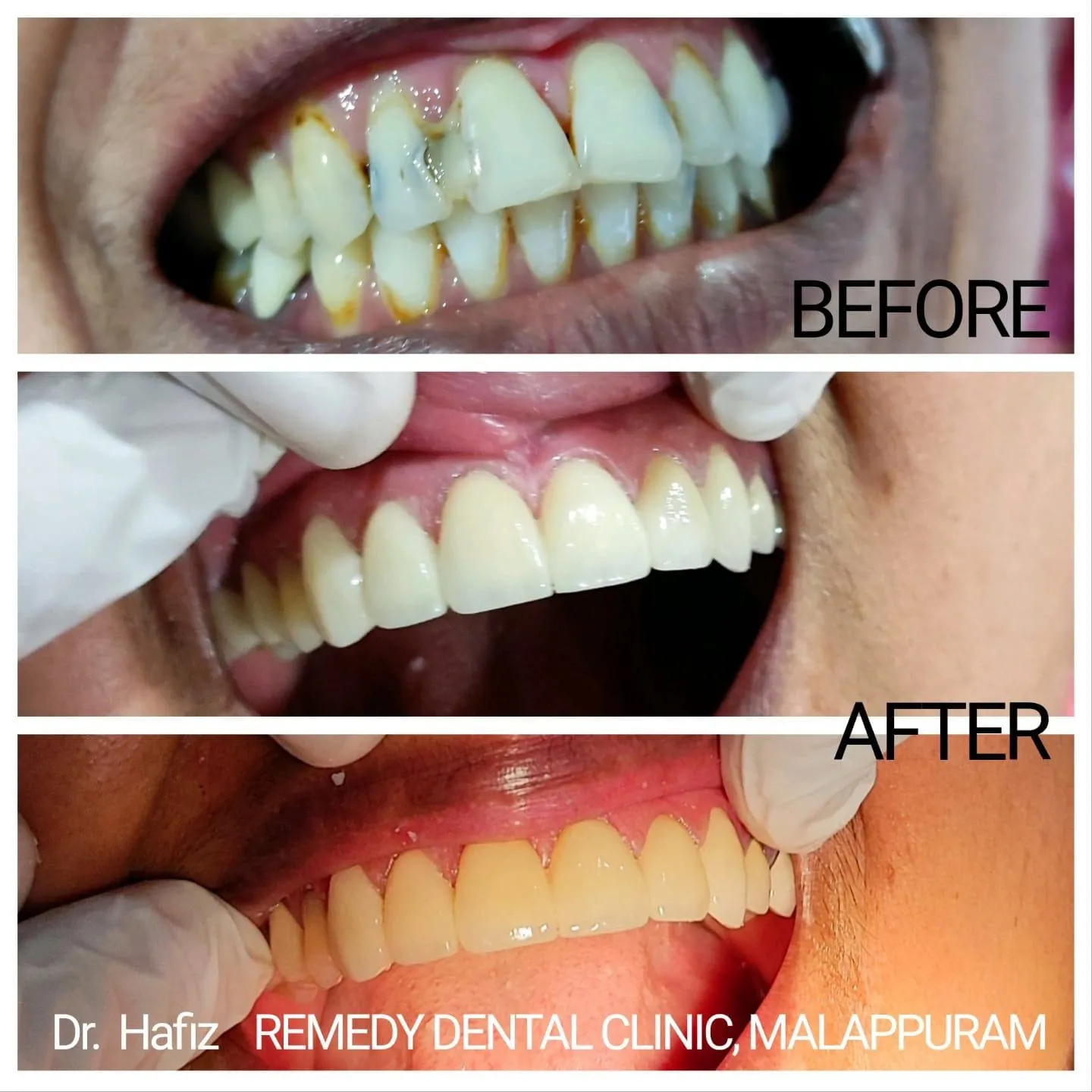 Dental veneers smile enhancement — before and after
